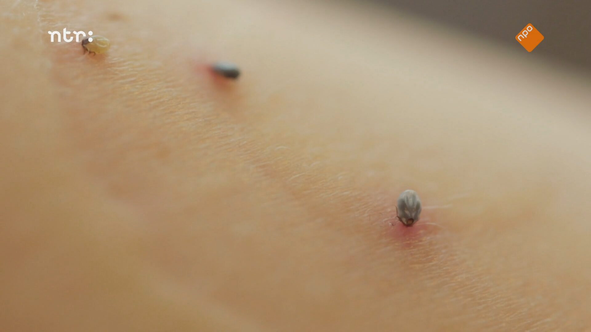 Een tekenbeet op de huid van persoon, de huid rondom de tekenbeet is rood.