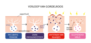 Verloop van gordelroos